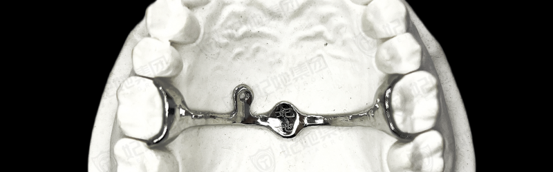 TPA+腭侧钩联合（3D一体成型）