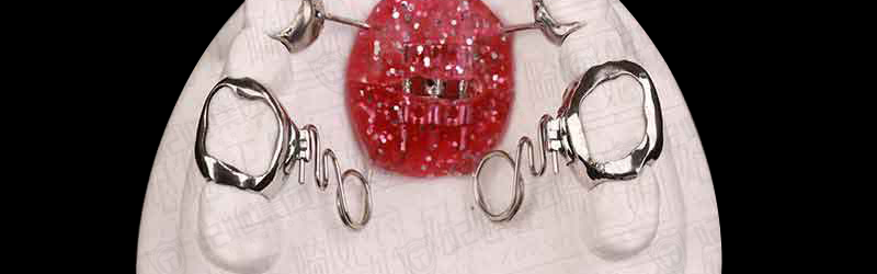 钟摆式螺旋簧磨牙后移矫治器