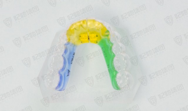 隐形横向扩弓矫治器（下颌）