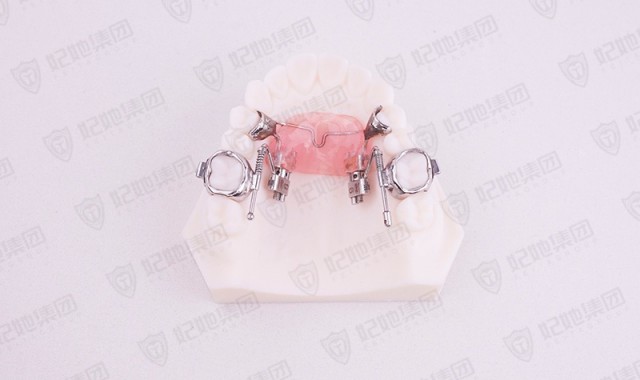 Forg蛙式双侧磨牙远移矫治器 