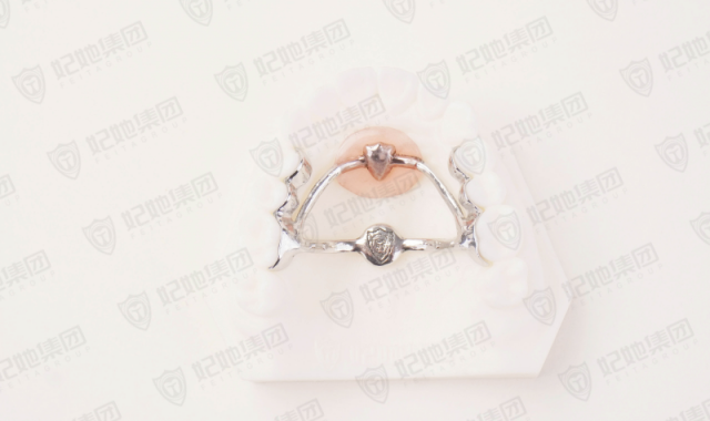 Nance托+TPA联合（3D一体成型）