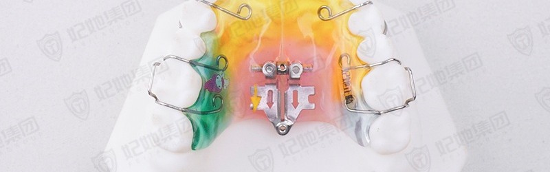 连体式扇形扩弓矫治器