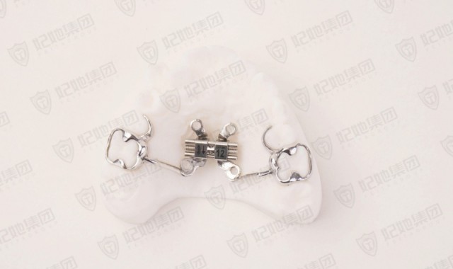 支抗钉骨性扩弓矫治器（铸造型MARPE)