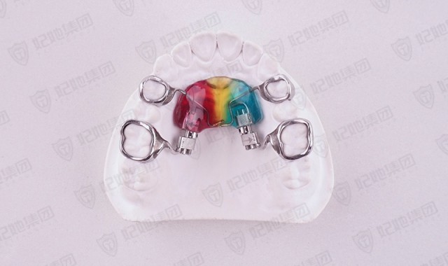 上颌支架式双侧异步磨牙后移矫治器（进口）