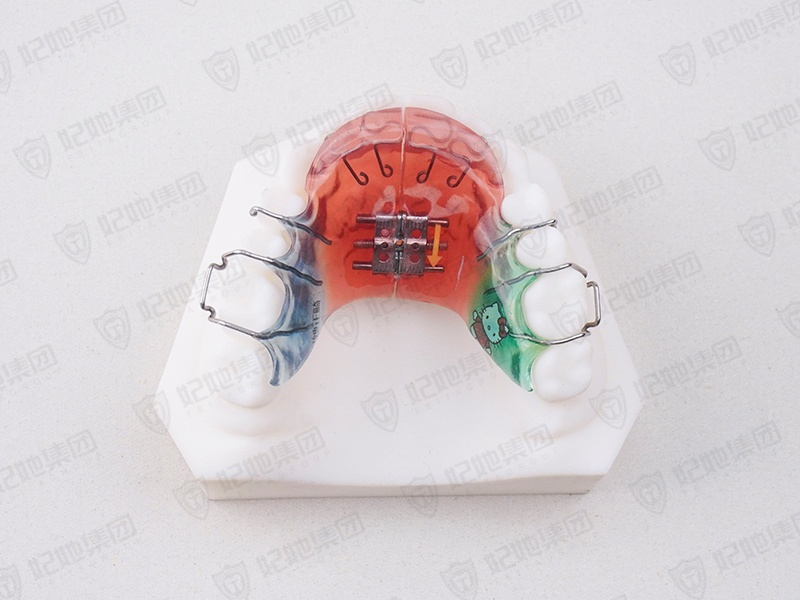 099-3-舌簧式螺旋簧横向扩弓矫治器（上颌）（德国进口）.jpg